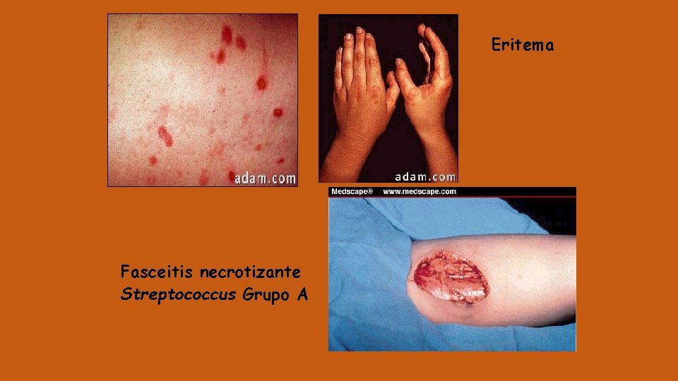 Eritema Fasceitis necrotizante Streptococcus Grupo A 