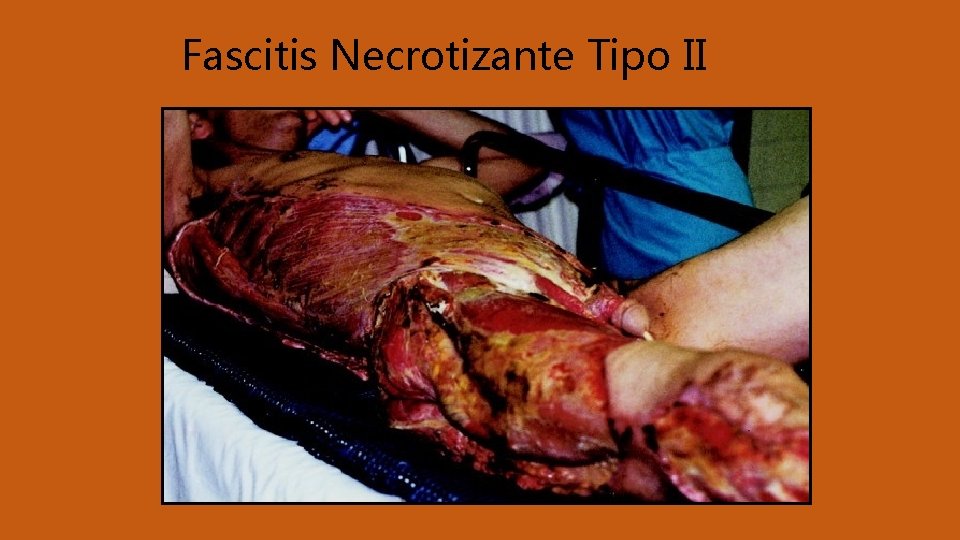 Fascitis Necrotizante Tipo II 
