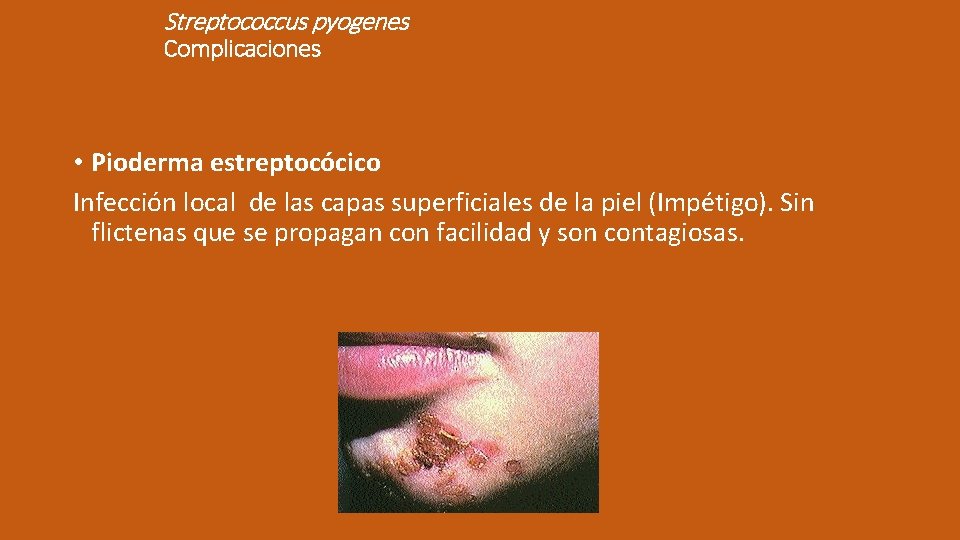 Streptococcus pyogenes Complicaciones • Pioderma estreptocócico Infección local de las capas superficiales de la