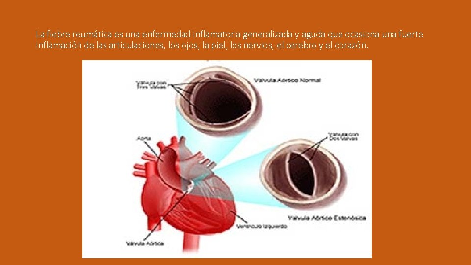 La fiebre reumática es una enfermedad inflamatoria generalizada y aguda que ocasiona una fuerte