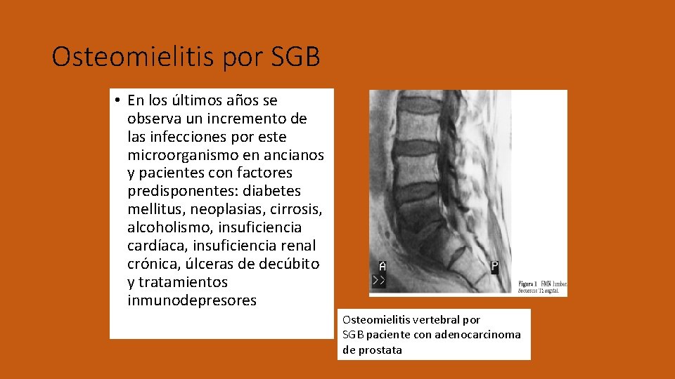 Osteomielitis por SGB • En los últimos años se observa un incremento de las