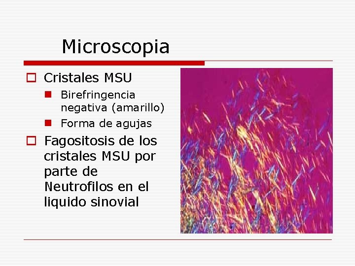 Microscopia o Cristales MSU n Birefringencia negativa (amarillo) n Forma de agujas o Fagositosis