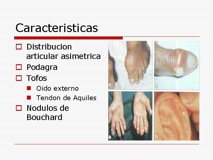 Caracteristicas o Distribucion articular asimetrica o Podagra o Tofos n Oido externo n Tendon