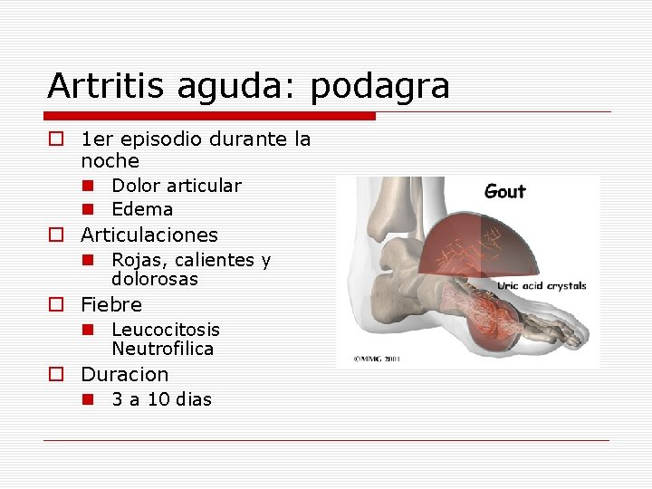 Artritis aguda: podagra o 1 er episodio durante la noche n Dolor articular n