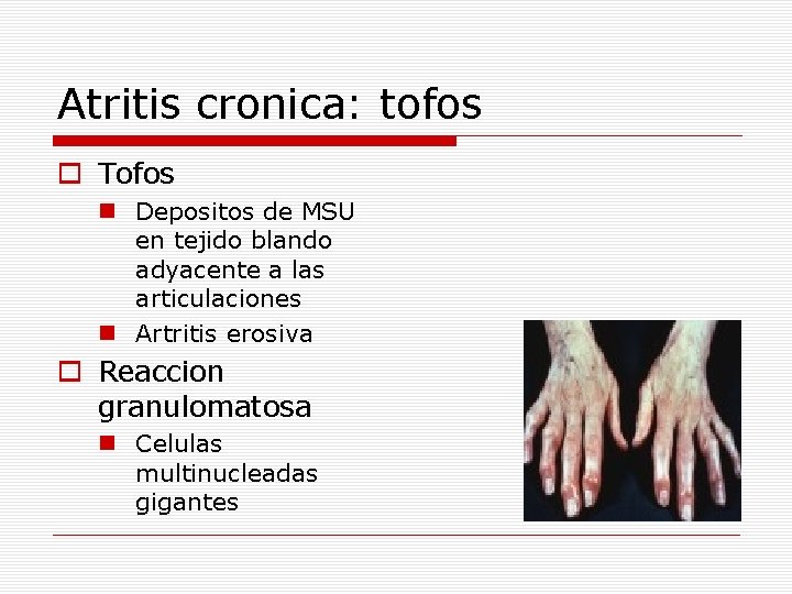 Atritis cronica: tofos o Tofos n Depositos de MSU en tejido blando adyacente a