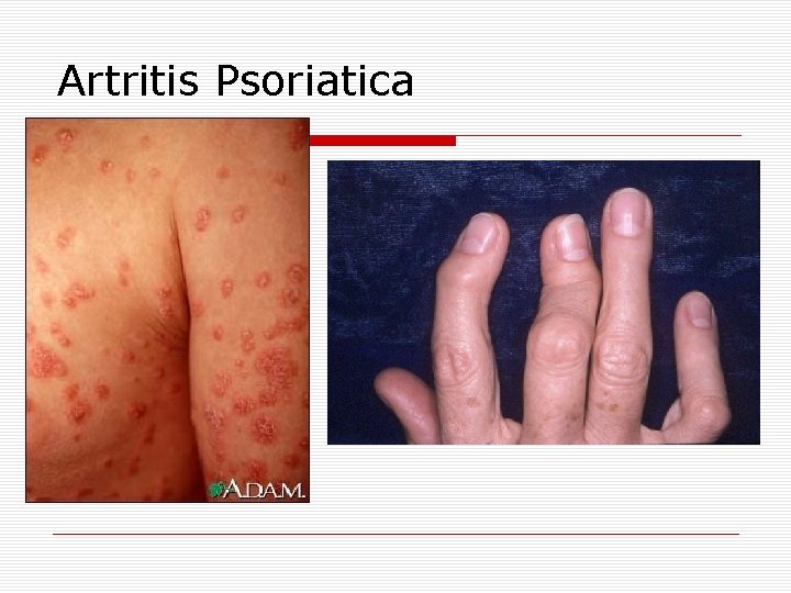 Artritis Psoriatica 