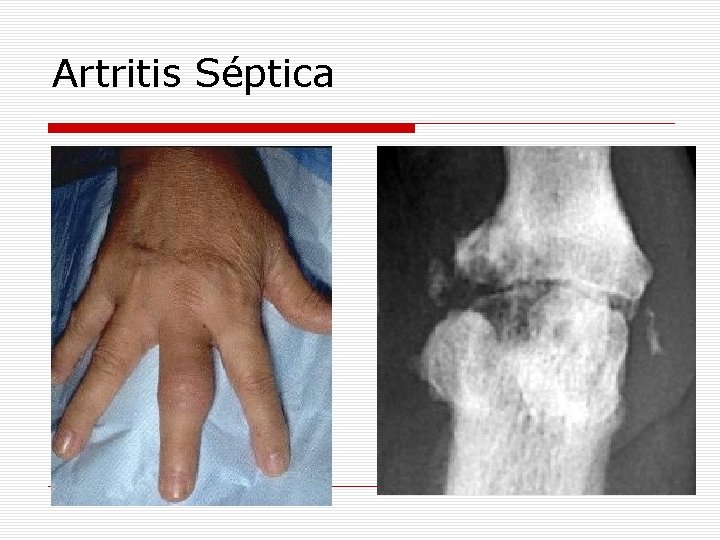 Artritis Séptica 