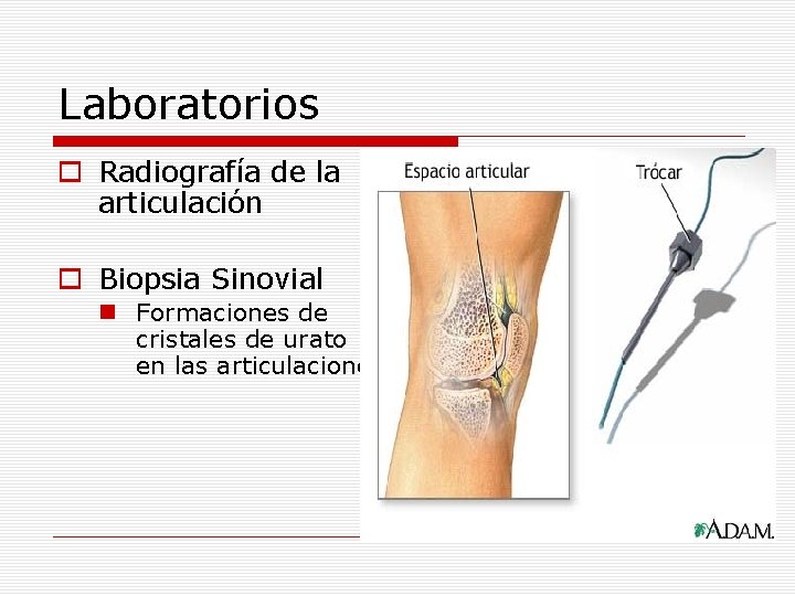 Laboratorios o Radiografía de la articulación o Biopsia Sinovial n Formaciones de cristales de
