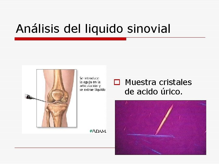 Análisis del liquido sinovial o Muestra cristales de acido úrico. 
