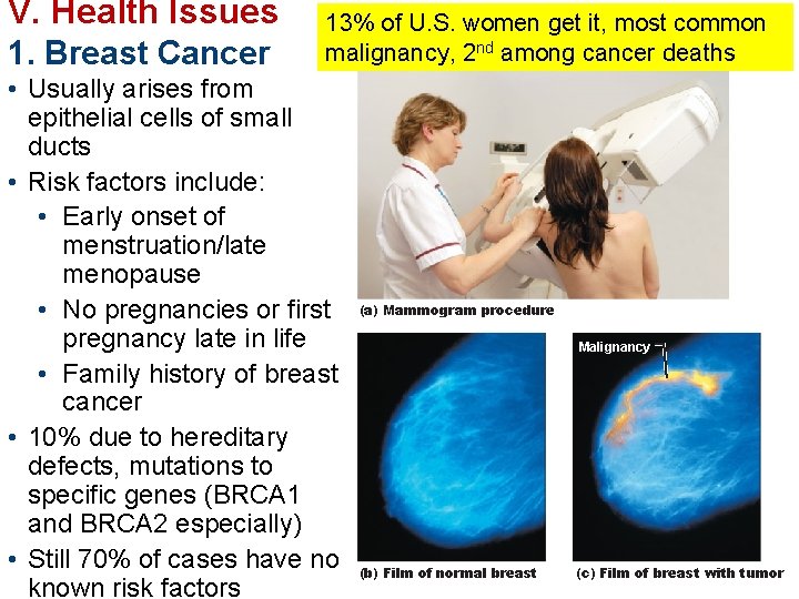 V. Health Issues 1. Breast Cancer 13% of U. S. women get it, most