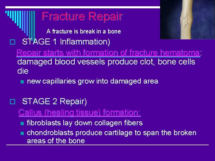 Fracture Repair A fracture is break in a bone o STAGE 1 Inflammation) Repair