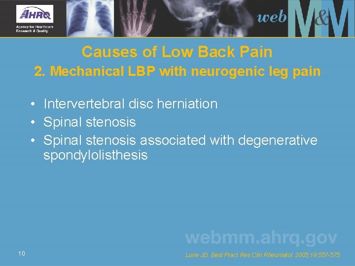 Causes of Low Back Pain 2. Mechanical LBP with neurogenic leg pain • Intervertebral