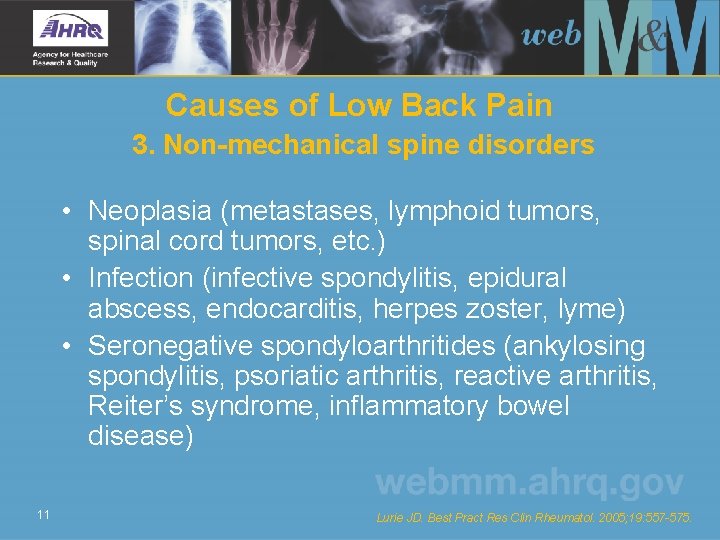 Causes of Low Back Pain 3. Non-mechanical spine disorders • Neoplasia (metastases, lymphoid tumors,