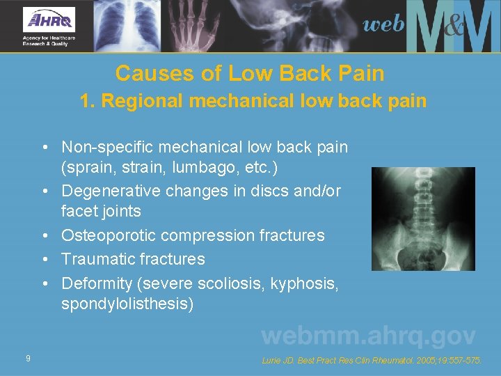 Causes of Low Back Pain 1. Regional mechanical low back pain • Non-specific mechanical