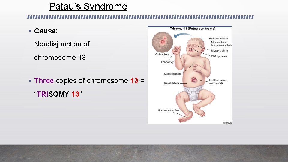 Patau’s Syndrome • Cause: Nondisjunction of chromosome 13 • Three copies of chromosome 13