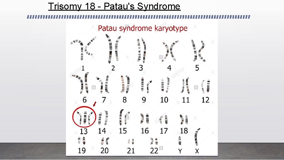 Trisomy 18 - Patau's Syndrome 