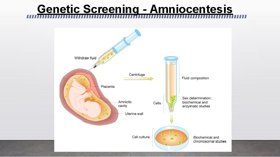 Genetic Screening - Amniocentesis 