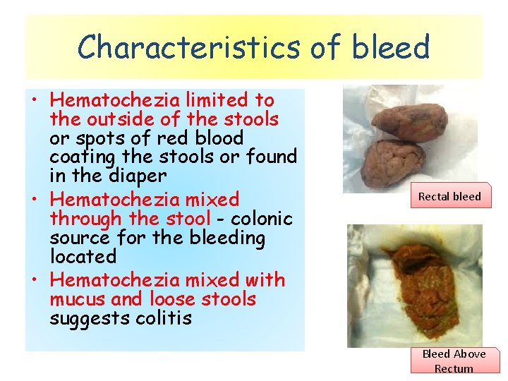 Characteristics of bleed • Hematochezia limited to the outside of the stools or spots