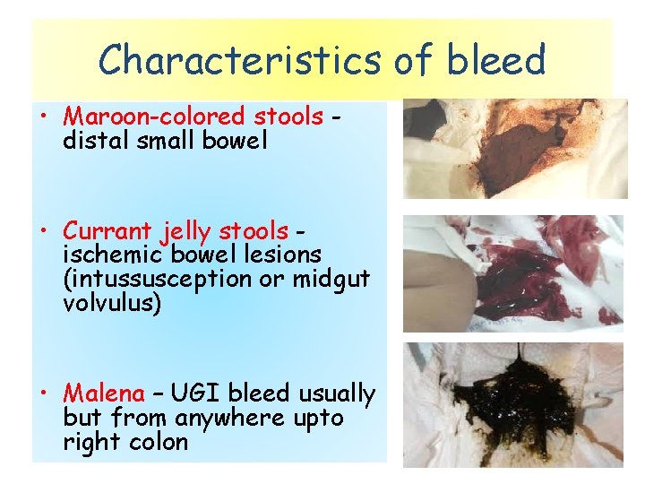 Characteristics of bleed • Maroon-colored stools distal small bowel • Currant jelly stools ischemic