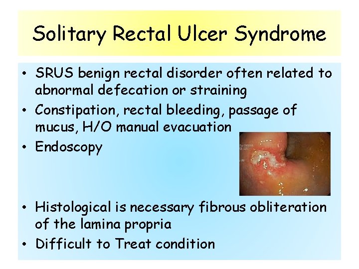Solitary Rectal Ulcer Syndrome • SRUS benign rectal disorder often related to abnormal defecation