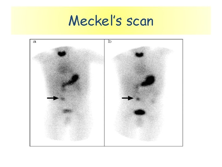 Meckel’s scan 
