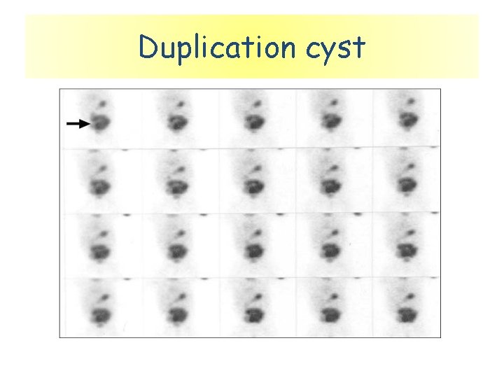 Duplication cyst 
