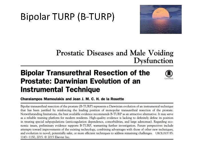 Bipolar TURP (B-TURP) 