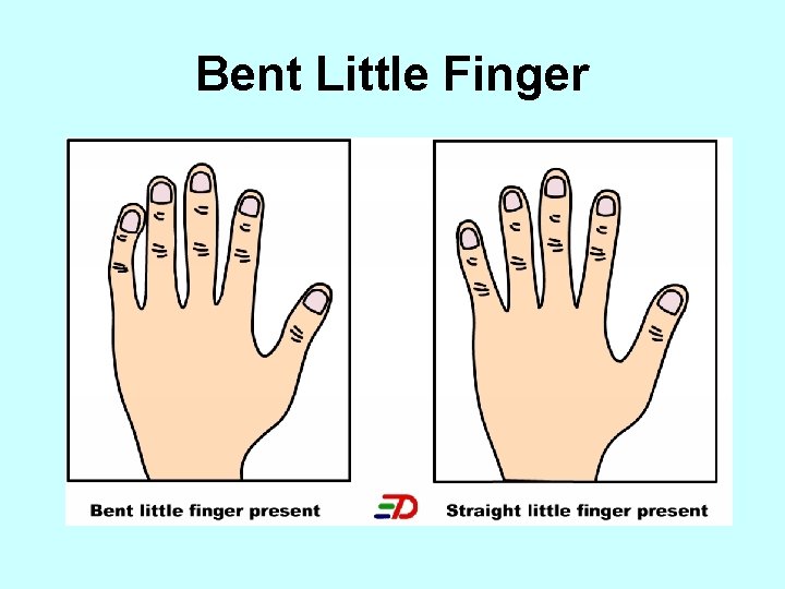 Bent Little Finger 