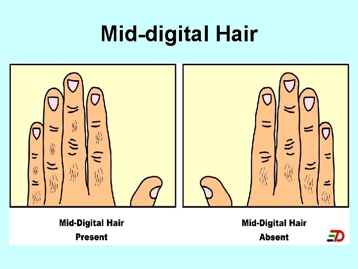 Mid-digital Hair 