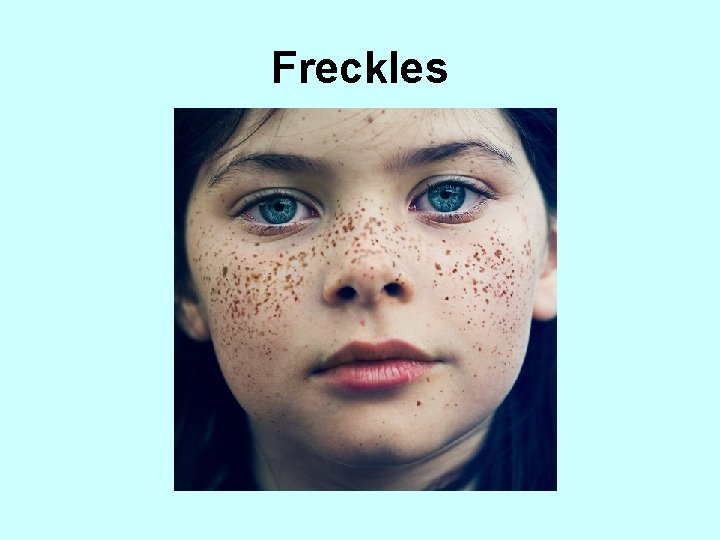 Freckles 