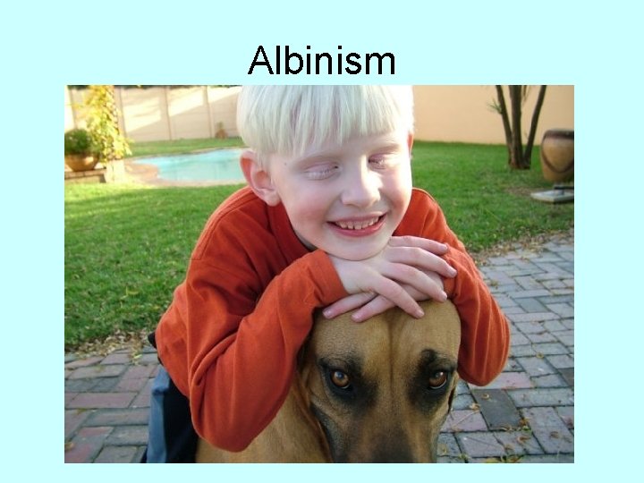 Albinism 