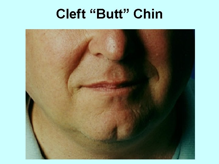 Cleft “Butt” Chin 