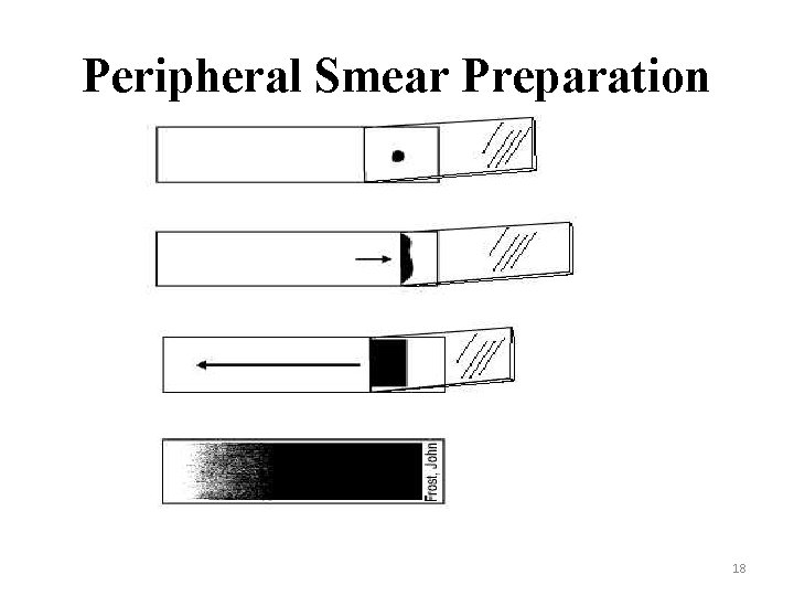 Peripheral Smear Preparation 18 