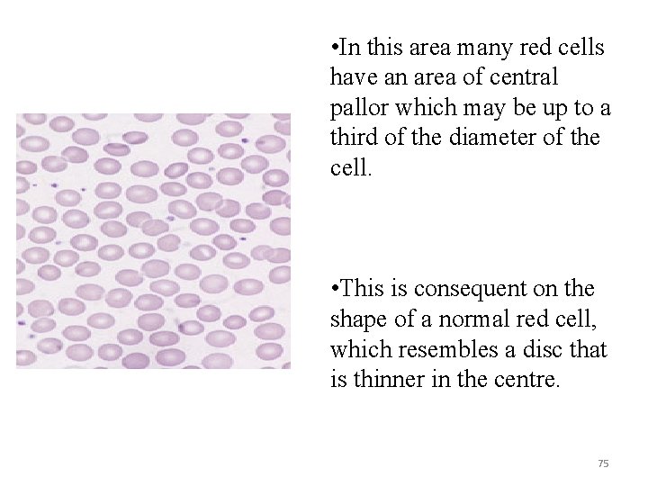  • In this area many red cells have an area of central pallor