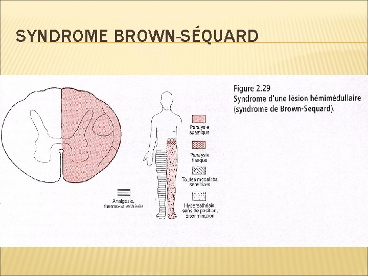 SYNDROME BROWN-SÉQUARD 