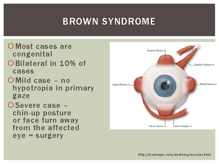 BROWN SYNDROME Most cases are congenital Bilateral in 10% of cases Mild case – BROWN SYNDROME Most cases are congenital Bilateral in 10% of cases Mild case –