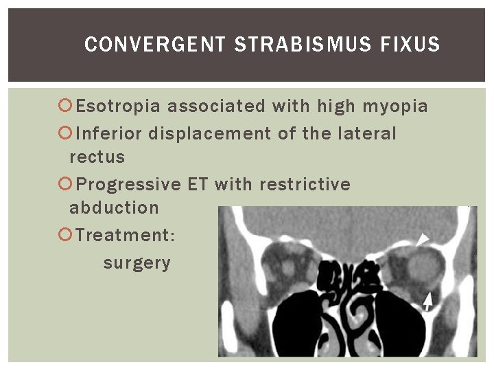 CONVERGENT STRABISMUS FIXUS Esotropia associated with high myopia Inferior displacement of the lateral rectus CONVERGENT STRABISMUS FIXUS Esotropia associated with high myopia Inferior displacement of the lateral rectus