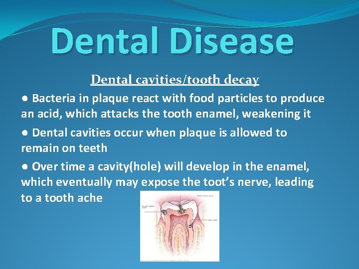 Dental Disease Dental cavities/tooth decay ● Bacteria in plaque react with food particles to