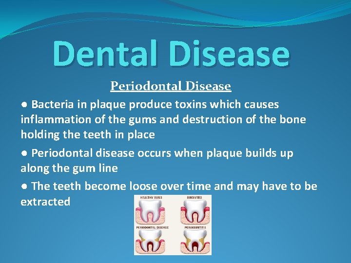 Dental Disease Periodontal Disease ● Bacteria in plaque produce toxins which causes inflammation of