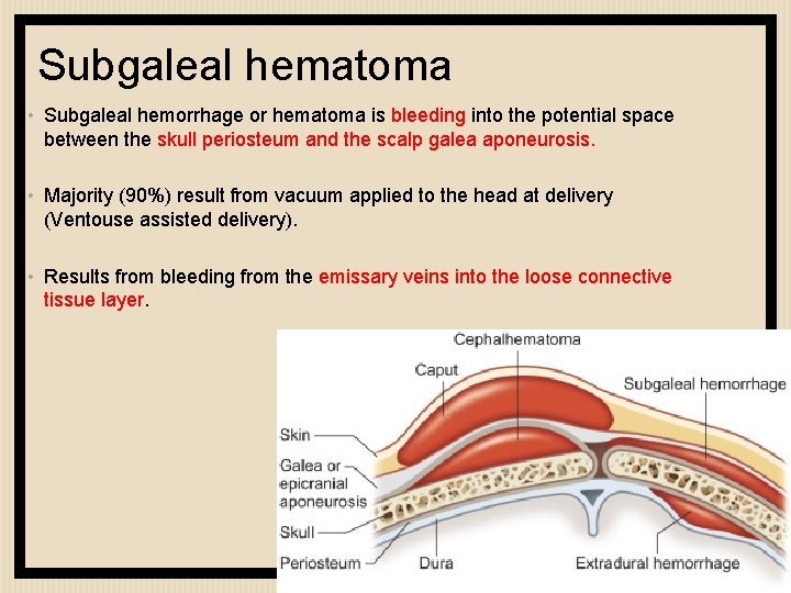 Subgaleal hematoma • Subgaleal hemorrhage or hematoma is bleeding into the potential space between