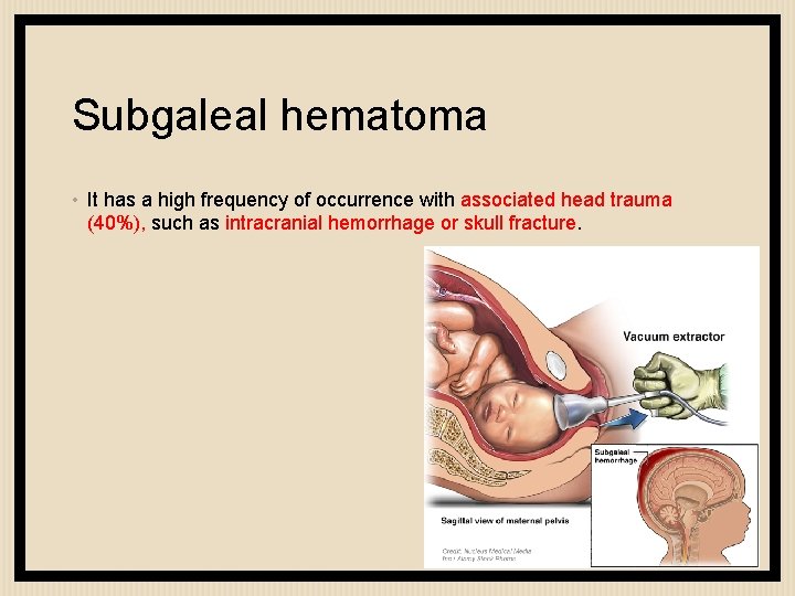 Subgaleal hematoma • It has a high frequency of occurrence with associated head trauma