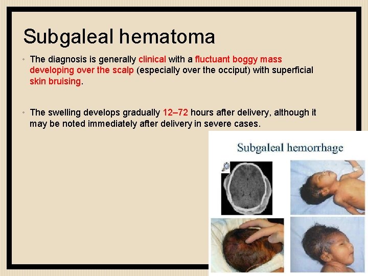 Subgaleal hematoma • The diagnosis is generally clinical with a fluctuant boggy mass developing