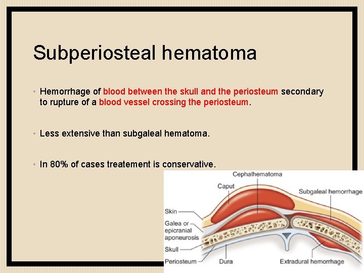 Subperiosteal hematoma • Hemorrhage of blood between the skull and the periosteum secondary to