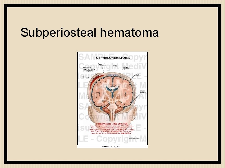 Subperiosteal hematoma 