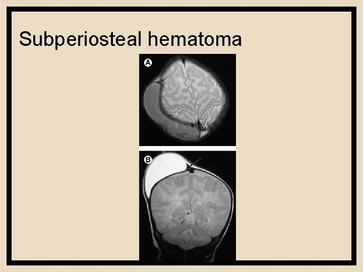 Subperiosteal hematoma 