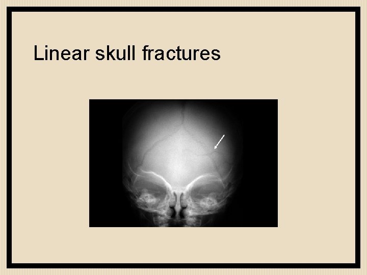 Linear skull fractures 