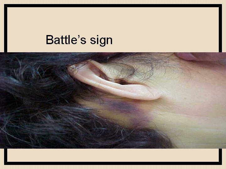 Battle’s sign 