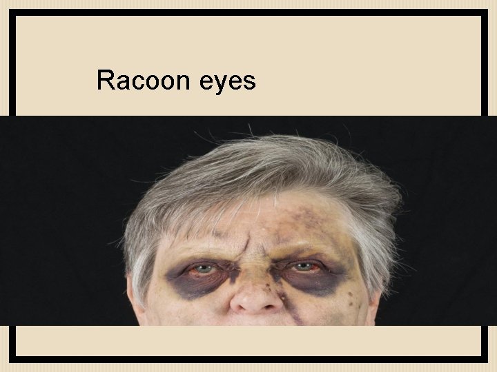 Racoon eyes 