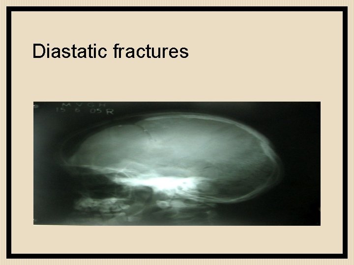 Diastatic fractures 