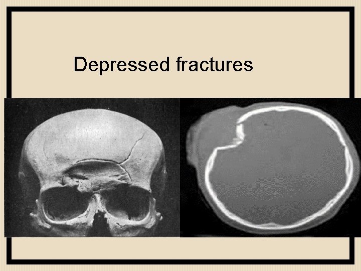 Depressed fractures 